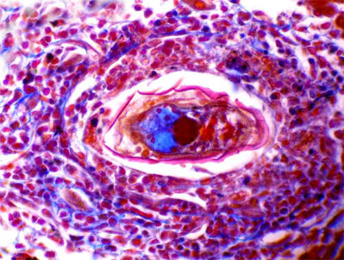 Fig 10. Corte de un granuloma bilharziano en hígado de roedor. Se observa claramente el miracidio dentro de un huevo rodeado por el granuloma.