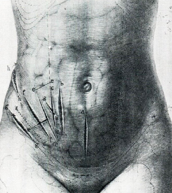 Tipos de incisión propuestos De Kelly HA, Hurdon E. 1905. WB Saunders