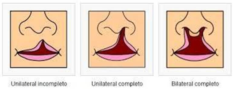 Fig 2. Tipos de labio leporino