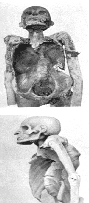 Figura 17. Mal de Pott en momia egipcia; el sacerdote Ammon de la XXI Dinastía.