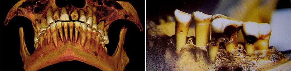Figura 21. A. Maxilar de la momia de un joven (2100 a. C.). B. Ablación de las caras oclusales.
