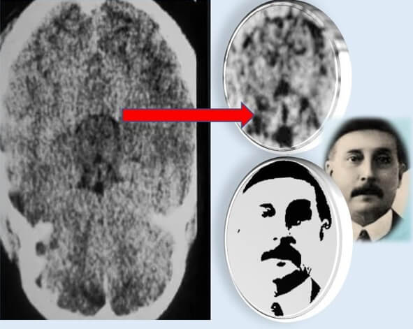 Figura 18. Imagen semejante al rostro del Dr. José Gregario Hernández que se observó en la radiografía invertida de una tomografía computarizada cerebral de un joven que había tenido un traumatismo craneal. Fotografía cortesía del Dr. Rafael Muci-Mendoza