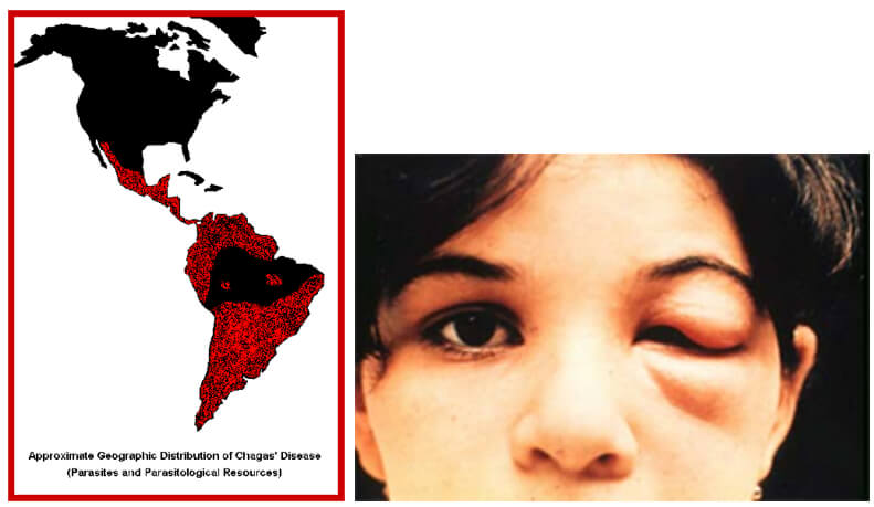 Fig. 14 (izquierda). Población humana en riesgo de contraer la ECh. Fig. 15 (derecha). Signo de Romaña: Inflamación en el párpado izquierdo, es un indicador de la ECh aguda, debido a que se colocaron en el ojo las heces depositadas por el insecto infectado por T. cruzi en la piel. Foto de WHO/TDR.