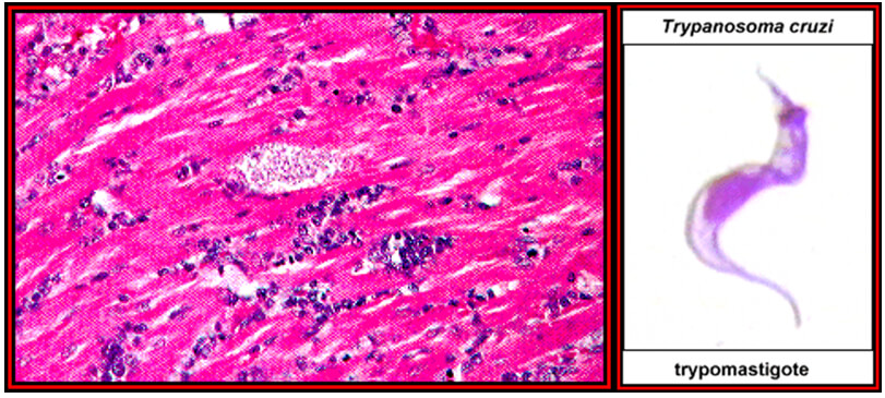 Fig. 16 (izquierda). Nidos de amastigotes en miocarditis chagasica. Fig. 17 (derecha) Tripomastigote en sangre periférica. 