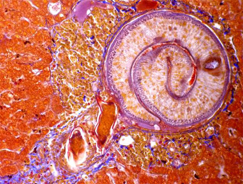 Fig 8. Granuloma bilharziano que engloba un verme macho adulto y 2 huevos degradados.