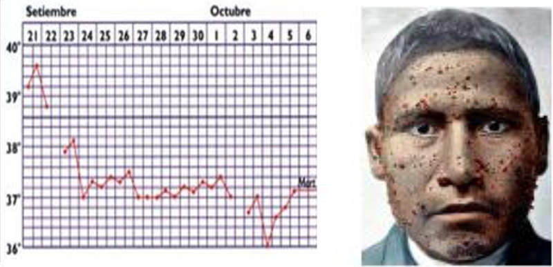 Fig. 4. Teoría Unicista de la enfermedad de Carrión. A la derecha, curva febril de Daniel Carrión, quien la padeció probablemente. A la izquierda, paciente con verruga peruana. Fuente: Odriozola E. La Maladie de Carrión ou La Verruga Peruvienne. Paris: 1898.