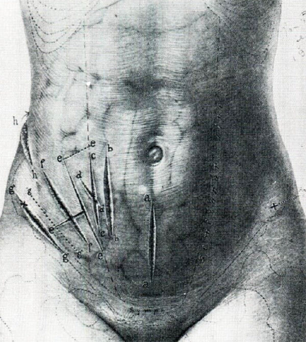 Fig 11. Tipos de incisión propuestos De Kelly HA, Hurdon E. 1905. WB Saunders