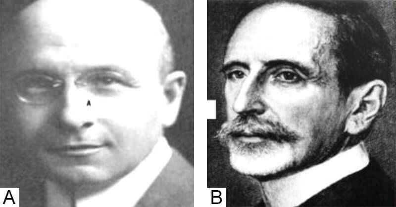 Fig. 3 Pioneros en cirugía cardíaca vascular, experimental. A. Dr. Alexis Carrel-Ricard, Premio Nobel de Físiología y Medicina, 1912. B. Dr. Theodore Tuffier, eminente cirujano francés, Hospitales Lariboisiére y Pitié de Paris.
