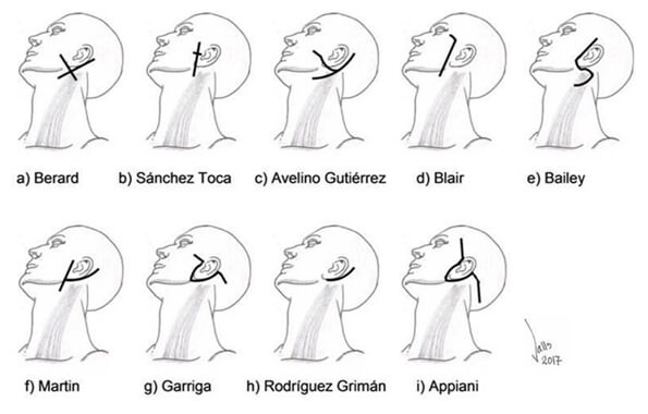 Fig 1. Incisiones faciales para parotidectomía.