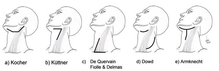 Fig 2. Incisiones para disecciones cervicales parciales.