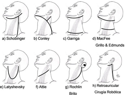 Fig 4. Incisiones para disección cervical radical posterior a radioterapia en altas dosis.
