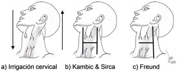 Fig 5. Irrigación arterial cutánea cervical e incisiones aparecidas luego de estudios (9-11).