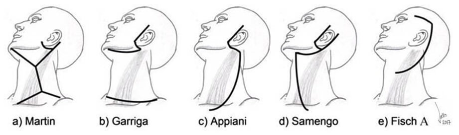 Fig 6. Incisiones cervico faciales para neoplasias malignas.