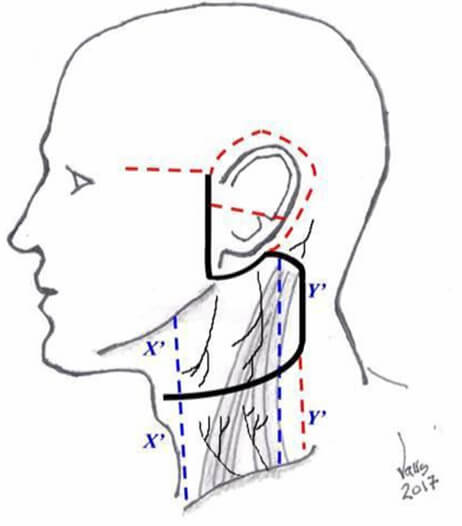 Fig 7. Incisión cervicofacial de colgajo superior adaptable para neoplasias malignas. (con letras y líneas interrumpidas azules distancia de bordes inf de mandíbula y sup de clavícula a rama transversal del abordaje. Los trazos interrumpidos rojos representan extensiones adaptables)