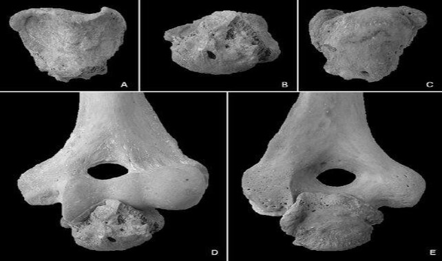 Fig. 12. Remanente del cúbito izquierdo de un individuo amputado. Vista anterior del cúbito (A); vista distal (B); vista posterior (C); articulado con el húmero izquierdo, vista anterior (D); y articulado con el húmero izquierdo, vista posterior (E).