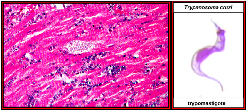 Fig. 16 (izquierda). Nidos de amastigotes en miocarditis chagasica. Fig. 17 (derecha) Tripomastigote en sangre periférica.