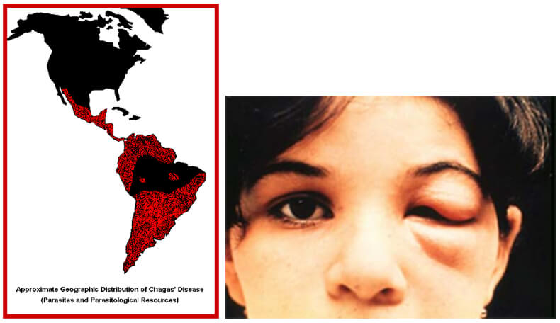 Fig. 14 (izquierda). Población humana en riesgo de contraer la ECh. Fig. 15 (derecha). Signo de Romaña: Inflamación en el párpado izquierdo, es un indicador de la ECh aguda, debido a que se colocaron en el ojo las heces depositadas por el insecto infectado por T. cruzi en la piel. Foto de WHO/TDR.