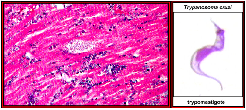 Fig. 16 (izquierda). Nidos de amastigotes en miocarditis chagasica. Fig. 17 (derecha) Tripomastigote en sangre periférica.