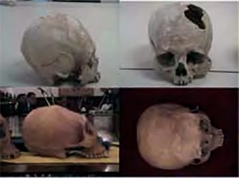 Figura 1. Deformación fronto-occipital de tipo tabular oblicuo de la zona de La Pica del Estado Aragua. Instituto de Antropología de la UCV.