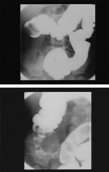 Figura 4 y 5. Invaginación intestinal antes y después de la reducción hidrostática.